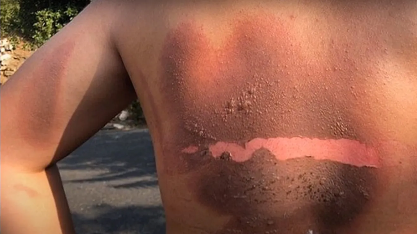 Súlyosan megsérült a kisfiú, miután felrobbant az ágyában a töltője – videó