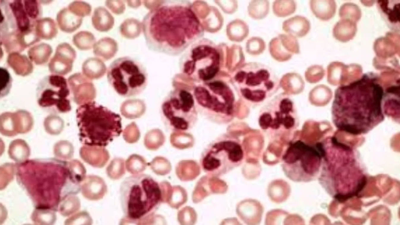 Magyar kutatás segítheti a leukémia kezelését