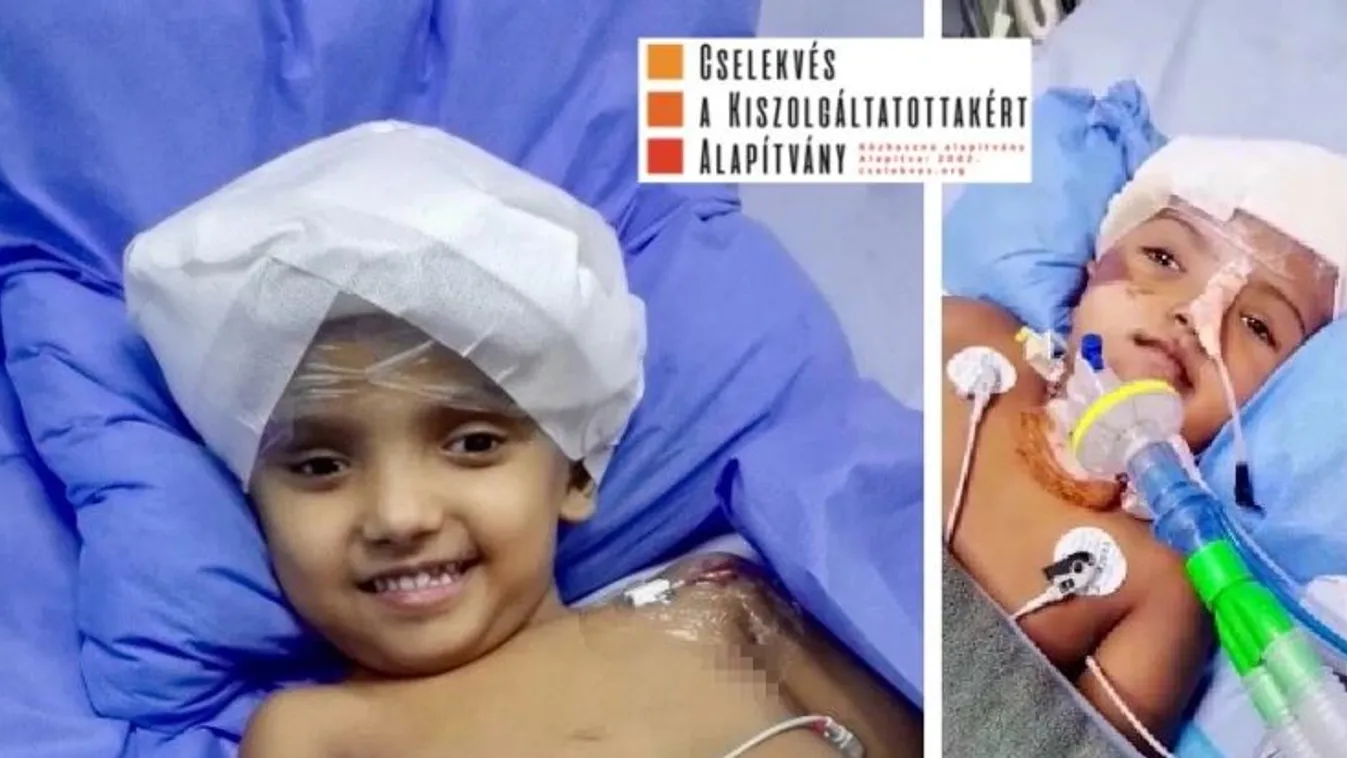 Most közölték: a szétválasztott sziámi ikerpár másik tagja, Rukaya is önállóan kinyitotta a szemét