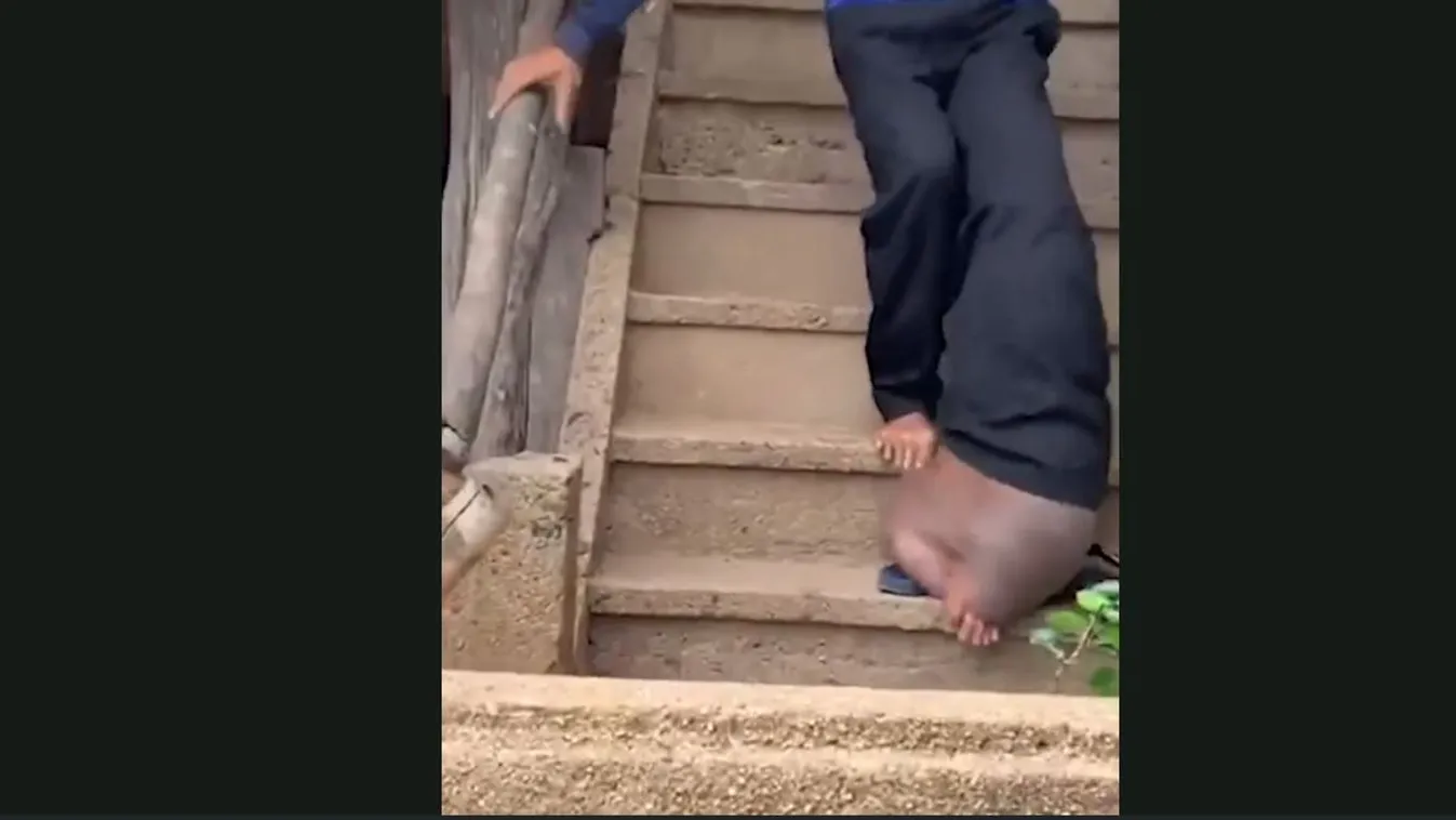 Borzalom: elkapart egy szúnyogcsípést, most már disznó méretűre dagadt lábbal, kínzó fájdalommal kell élnie