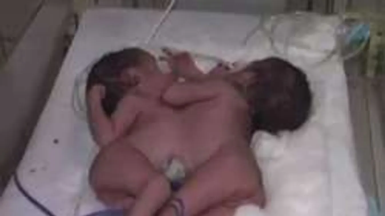 Sziámi ikrek születtek Indiában - VIDEÓ!