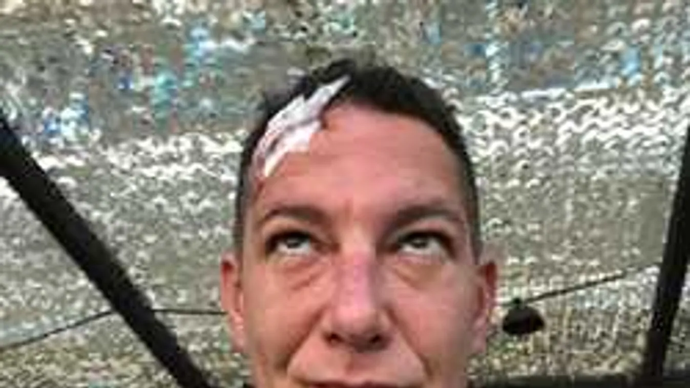 Egy rossz mozdulat miatt nyolc öltéssel varrták össze a magyar színész fejét - Fotók