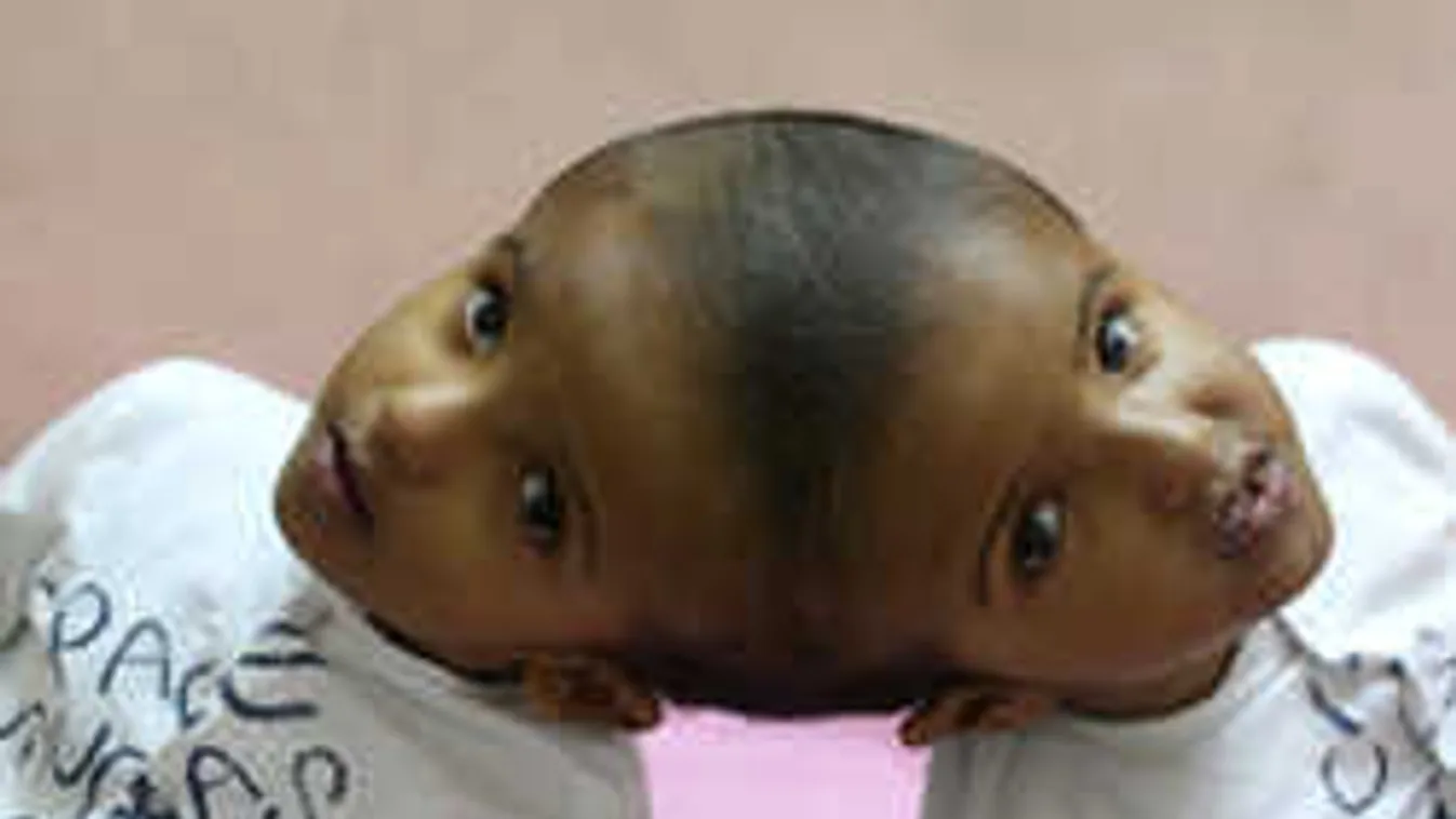 Erre vártunk, itt a nagy fordulat a fejüknél összenőtt sziámi ikrek ügyében