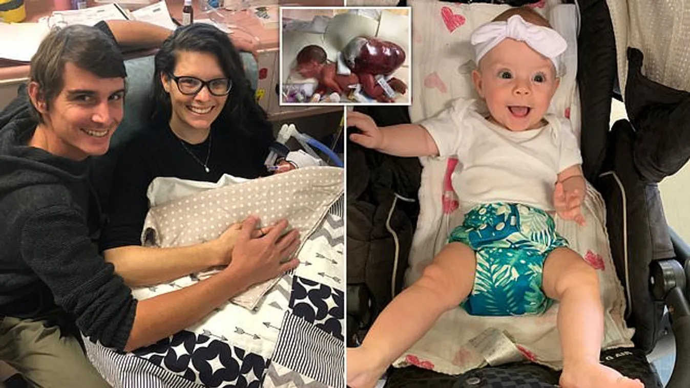 „A tumor nagyobb volt, mint ő” – rácáfolt az esélyeire az újszülött kislány – fotó