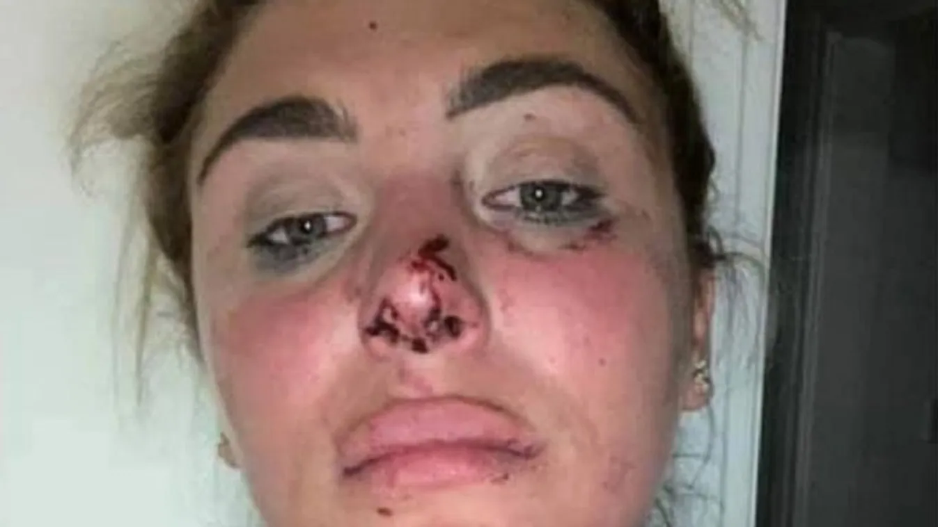 „Könyörögtem neki, hogy hagyja abba„ – brutálisan megverte az exe a fiatal nőt – megrázó fotók