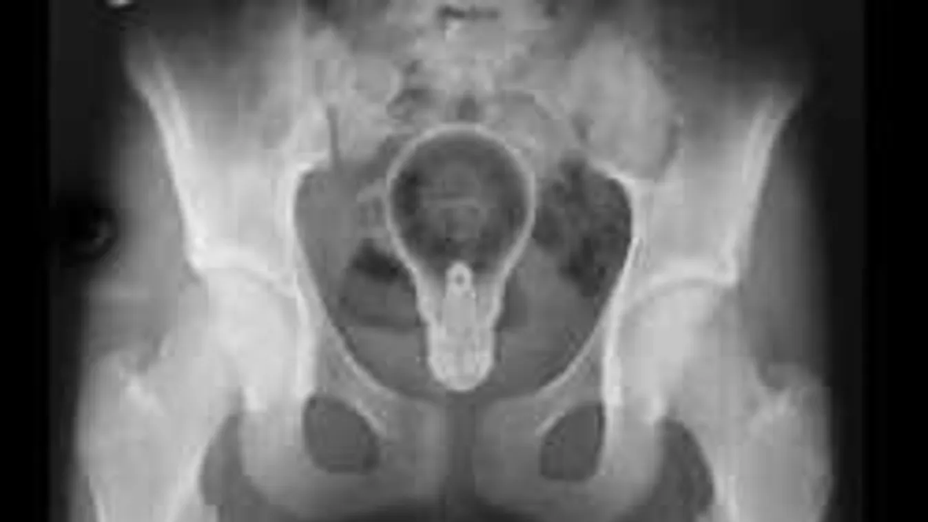 Sokkoló röntgenfelvételek! Ezeket a holmikat mind nők vaginájában találták...