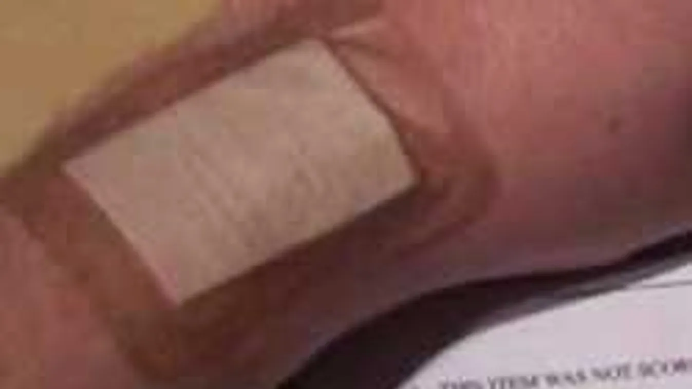 Kifejlesztették a ragasztót, ami egy perc alatt begyógyítja a sebeket
