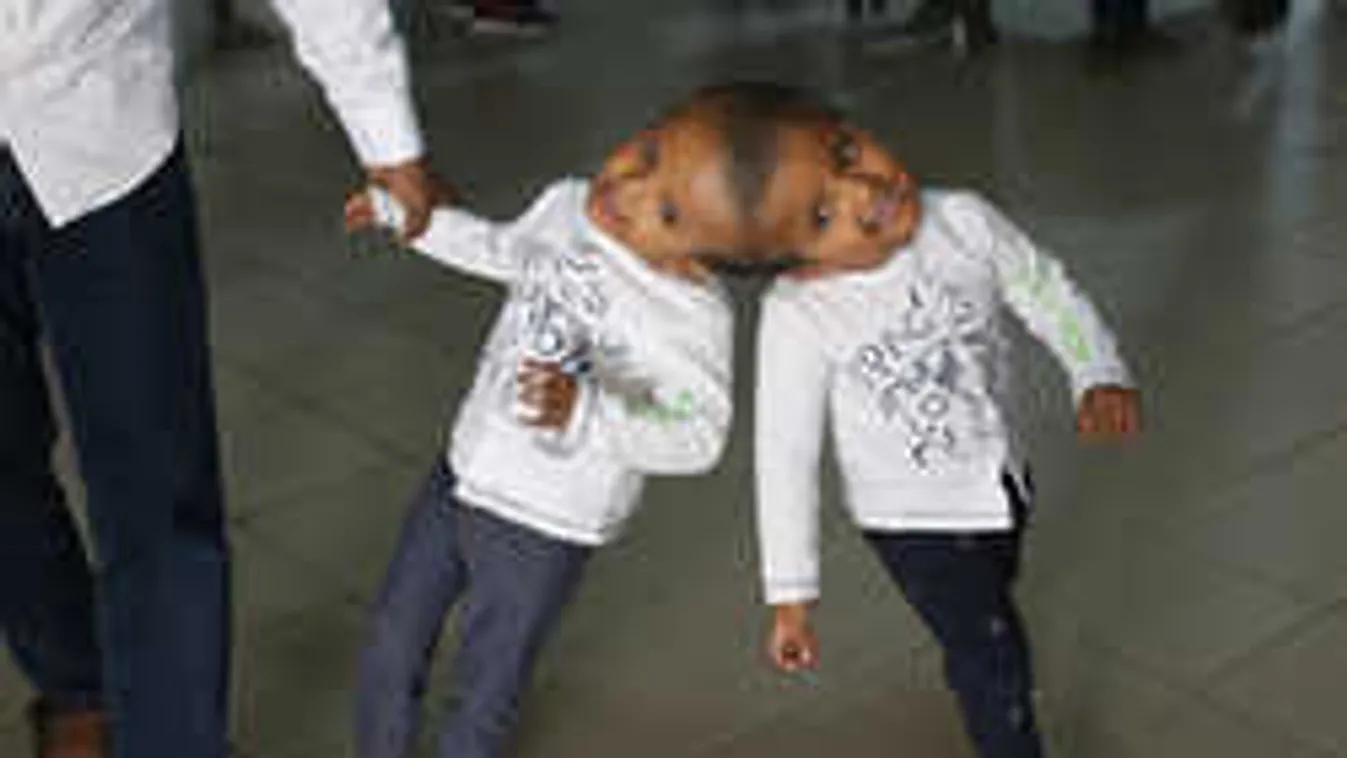 Pénzt gyűjtenek a sziámi ikrek műtétjére