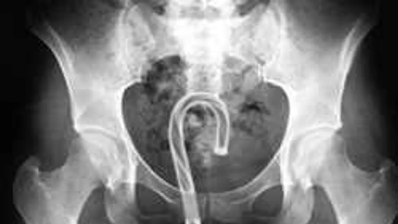 Nem hiszed el, miket találnak a nők vaginájában - sokkoló röntgenfotók!