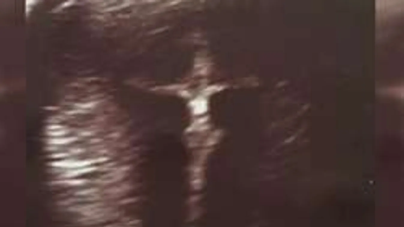 Sosem találnád ki, mit látott a kismama az ultrahangos képen!