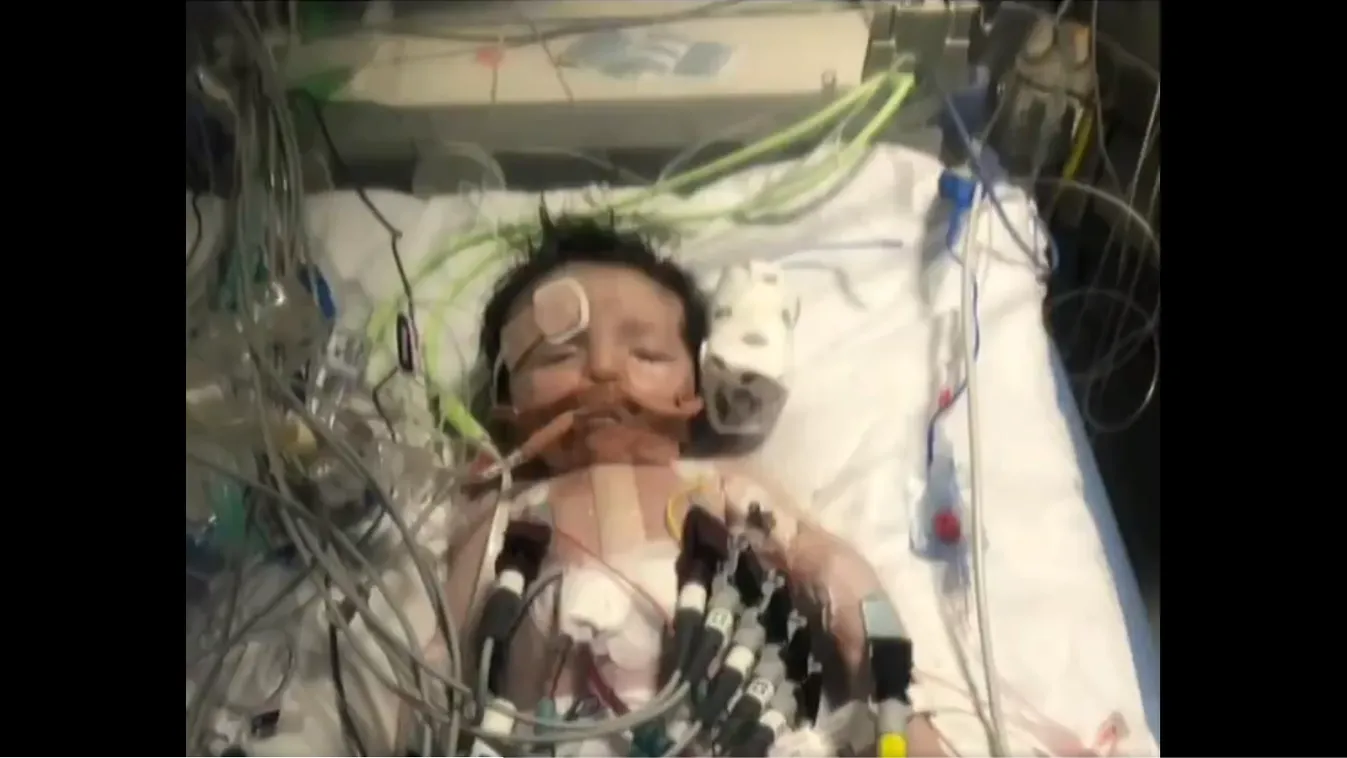 13-szor kellett újraéleszteni: négy hét után vették észre az újszülött szívbetegségét