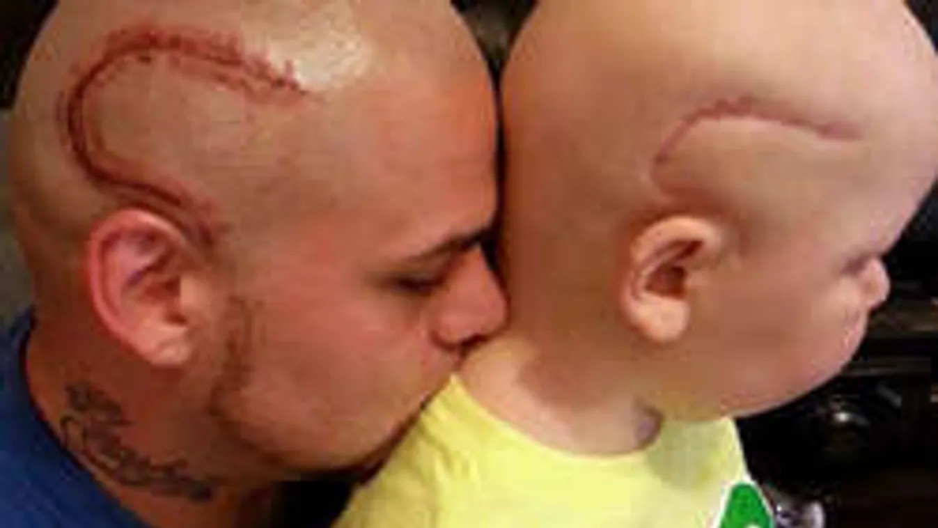 Szívszorító: magára tetováltatta kisfia rémes sebét az apuka