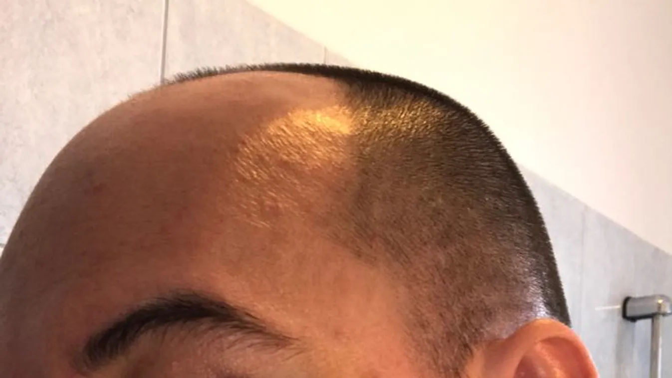 Ömlött az arcából a vér a balesetet szenvedett biciklisnek