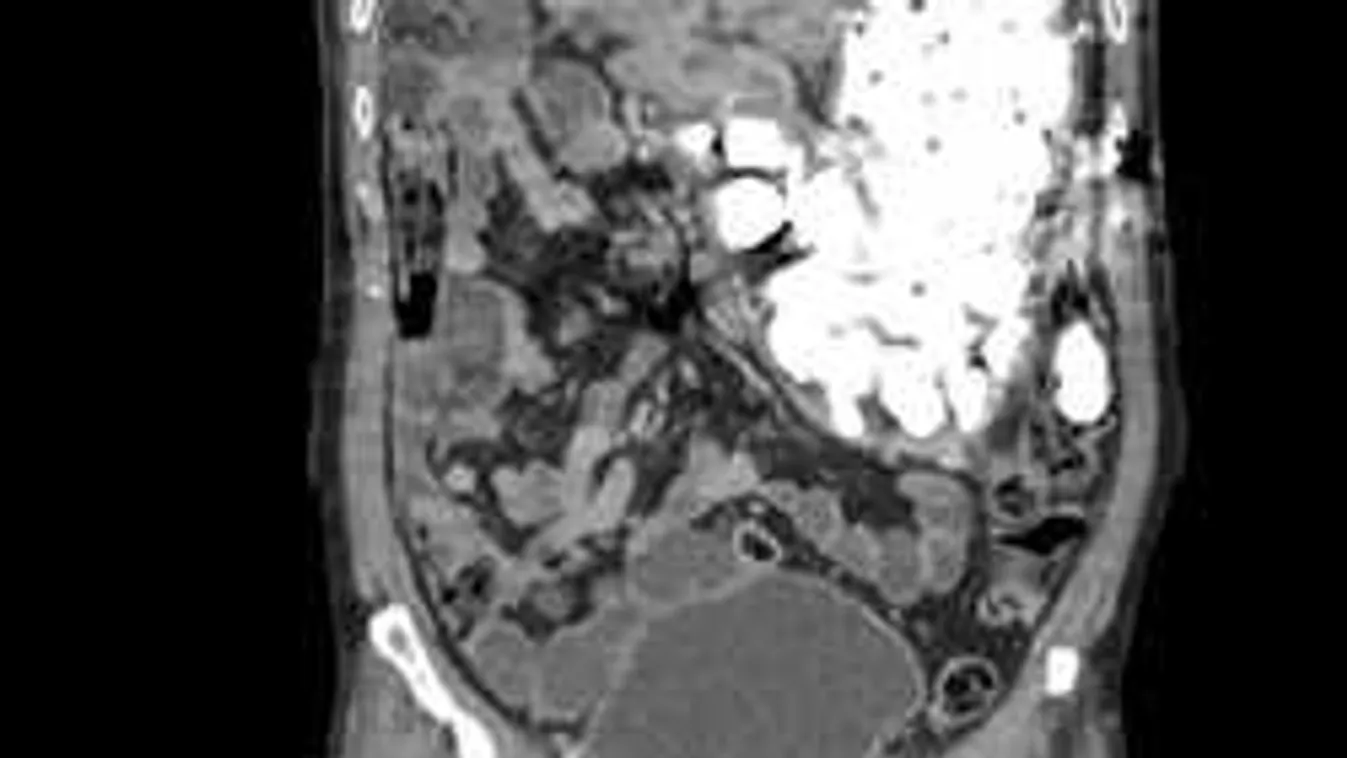 Sokkot kapott az orvos, amikor meglátta, mi van páciense hasában