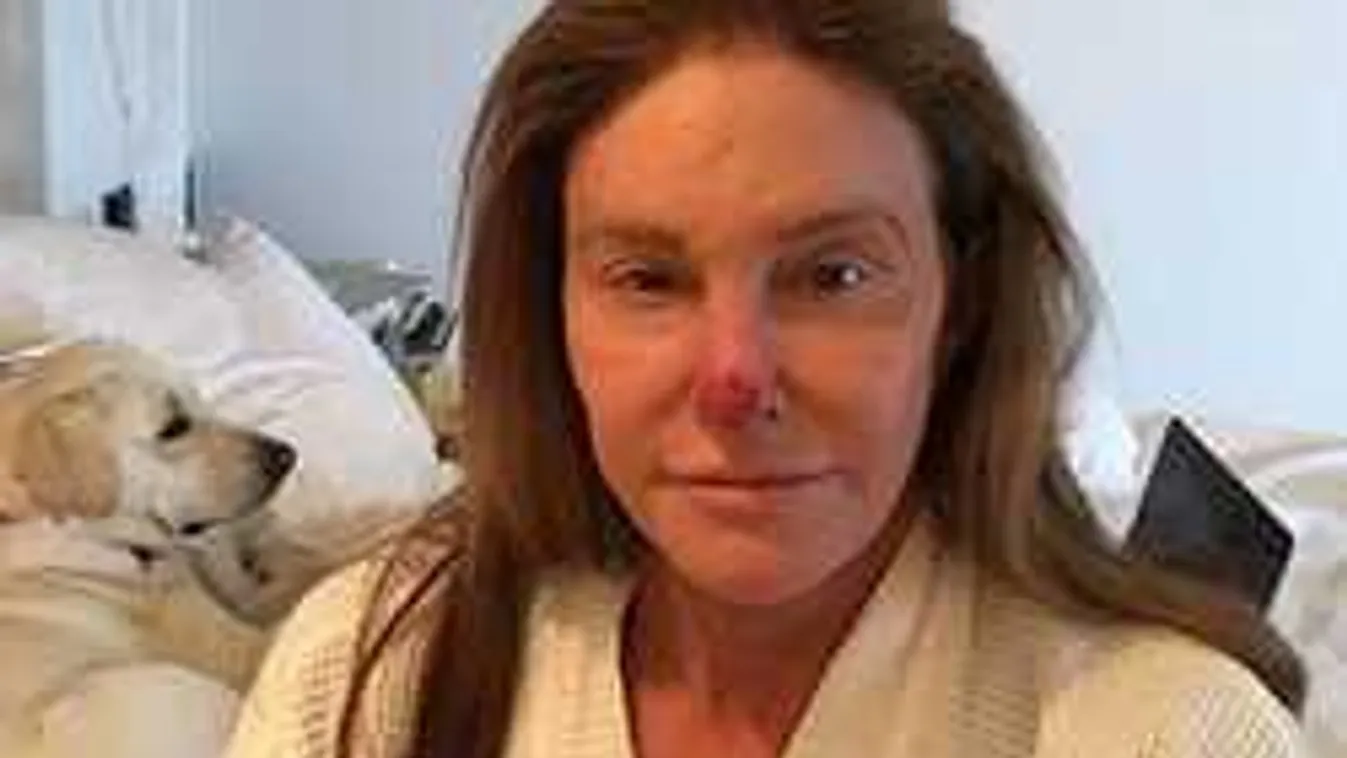 Brutális fotót osztott meg sérüléséről az átoperált sztár