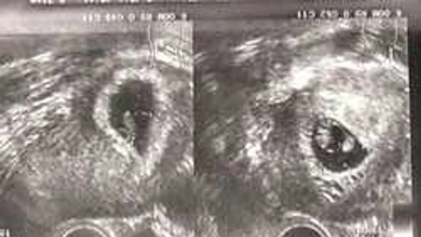 Sokkot kaptak az orvosok, amikor császármetszéskor felnyitották a nő hasát