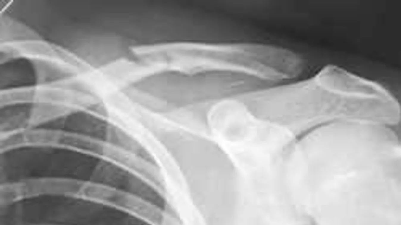 Horrorvideó! Síbalesetben törte csontját Beckham!