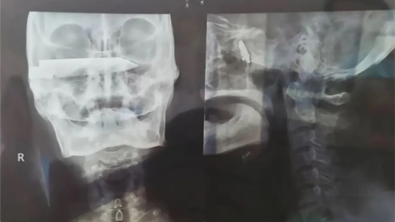 Még az orvosok is sokkot kaptak, amikor meglátták, mi volt a férfi koponyájában 26 évig