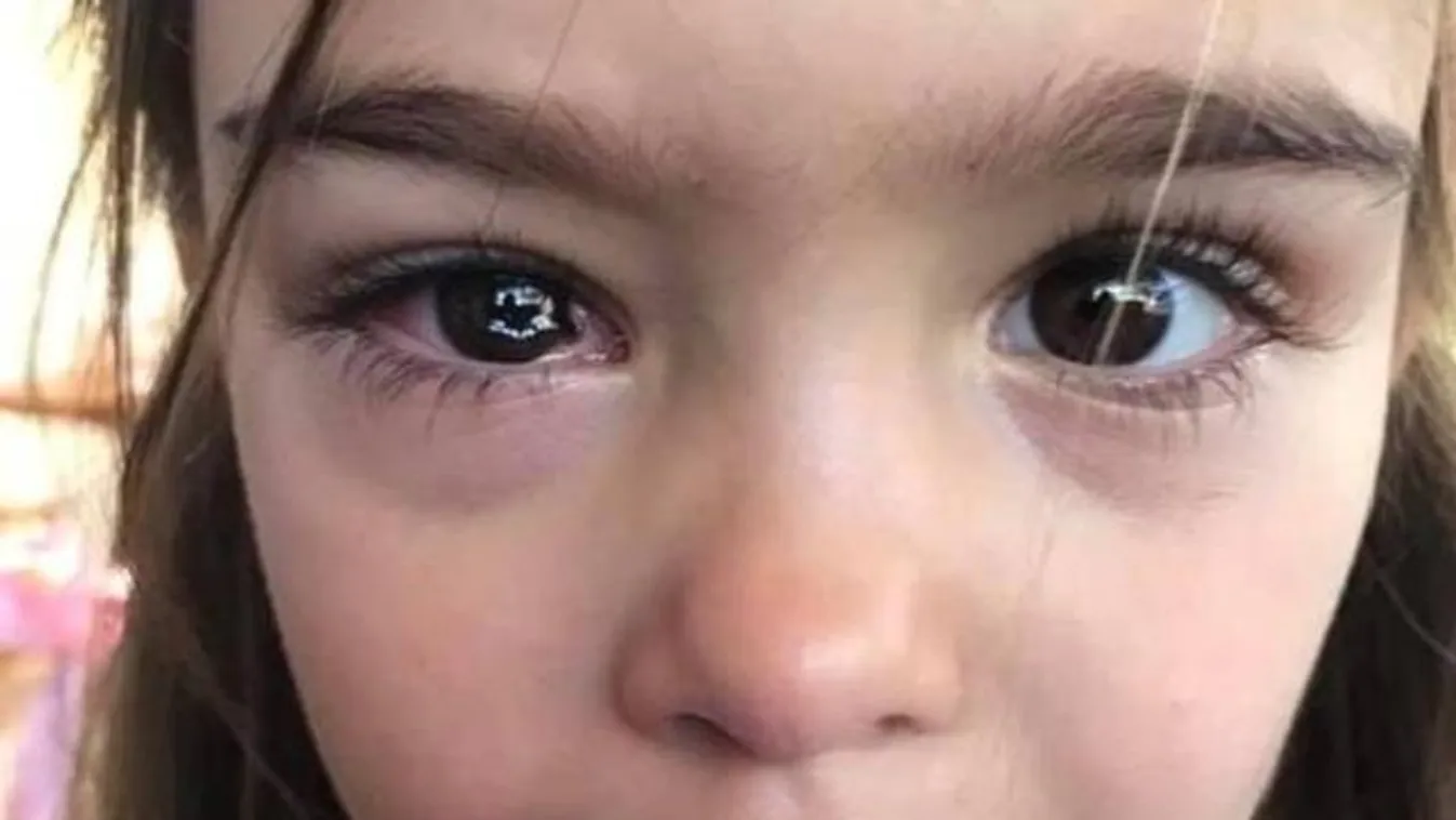 „Azt hittem, a lányom biztonságban van” – brutális sérülése majdnem megvakította a 4 éves kislányt