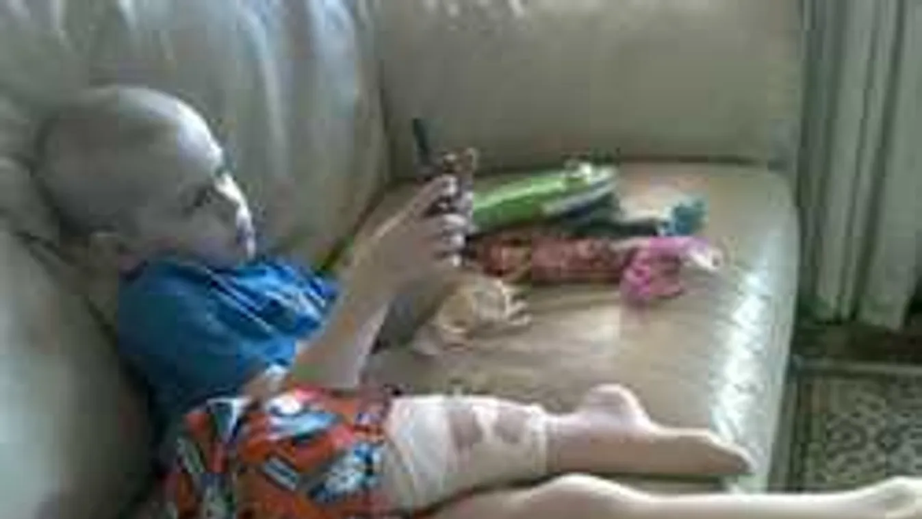 Hátrafordították a gyerek lábát,hogy ne kelljen amputálni