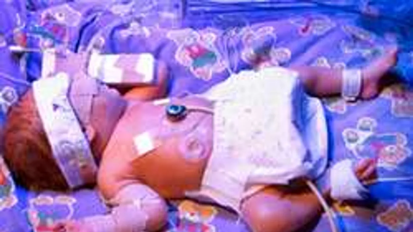 Orvosi csoda: Teljesen felépülhet az egyik törökszentmiklósi kisbaba