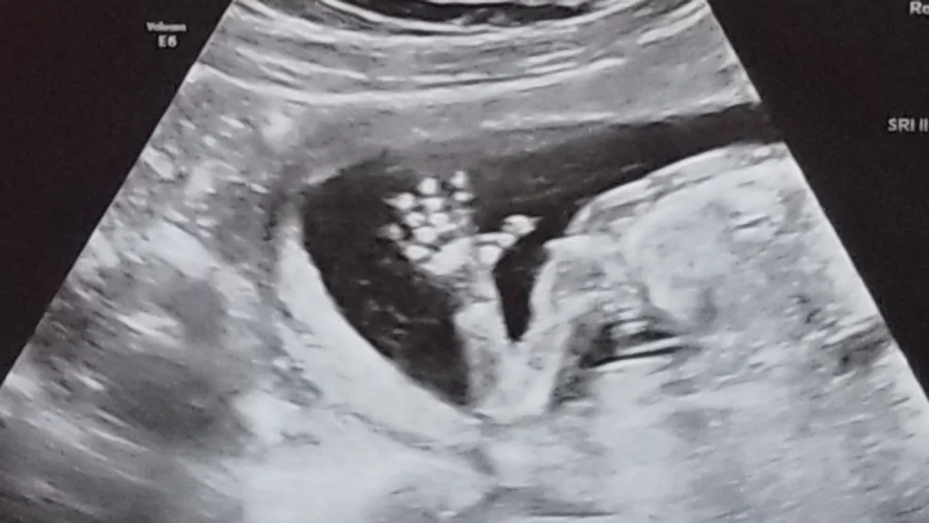 Sokkot kapott az orvos, amikor meglátta a nő intim ultrahangját