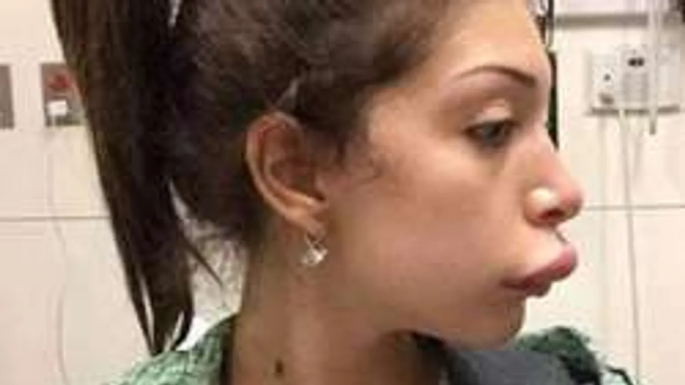 Íme az elcseszett szájplasztikaverseny döntősei!