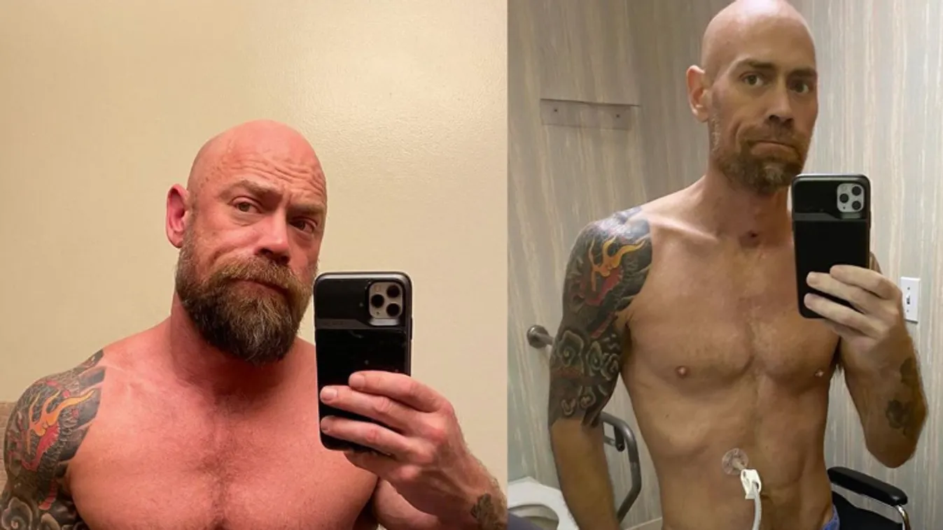 Döbbenetes fotók: a koronavírus-túlélő teste lényegében elsorvadt a betegségtől!