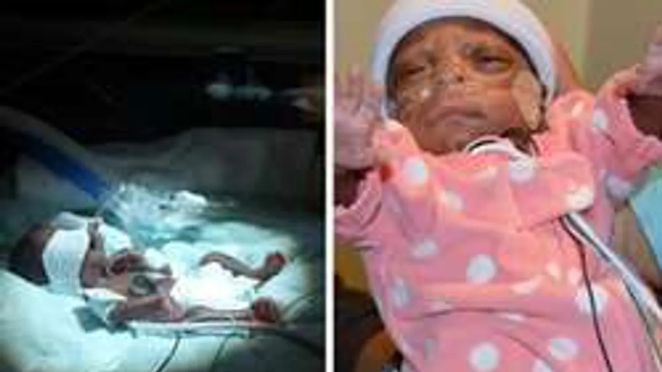 Ünnepi csoda: hazaengedték a világ egyik legkisebb súllyal született babáját