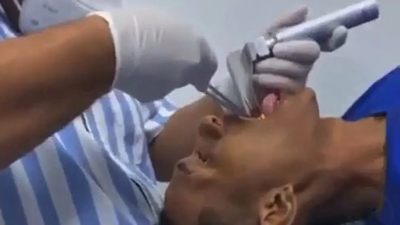 Sokkoló röntgenfelvétel: szörnyű, mit húztak ki a fiatal férfi szájából