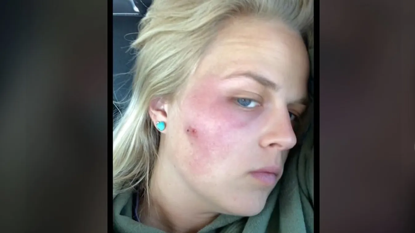 Azt hitte, csak egy pattanás, ám amikor kinyomta, sokkoló dolog történt – videó