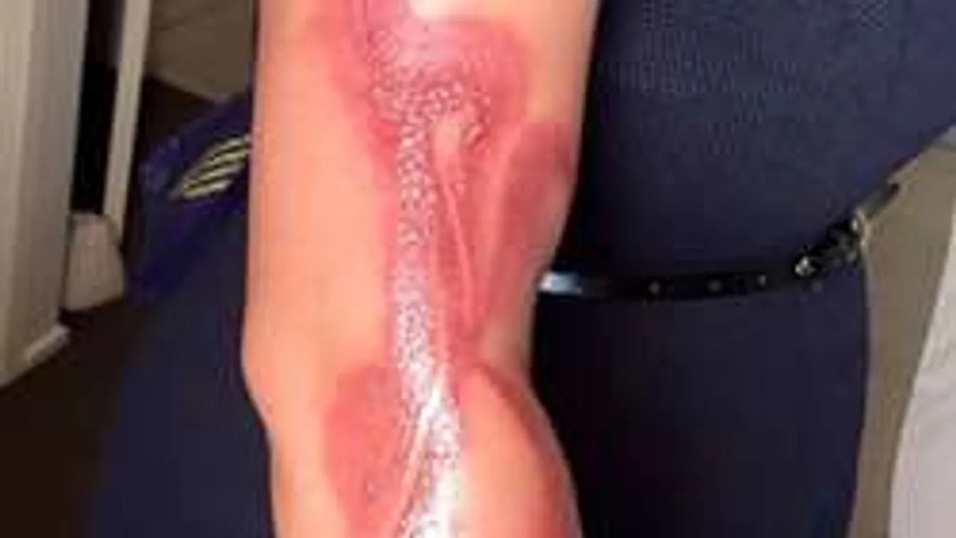 Ne aludj telefonnal! Ennek a kismamának beleégett a karjába a mobil