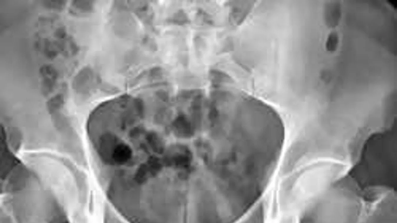 Addig játszadozott otthon magával, míg durva szexbaleset lett a vége