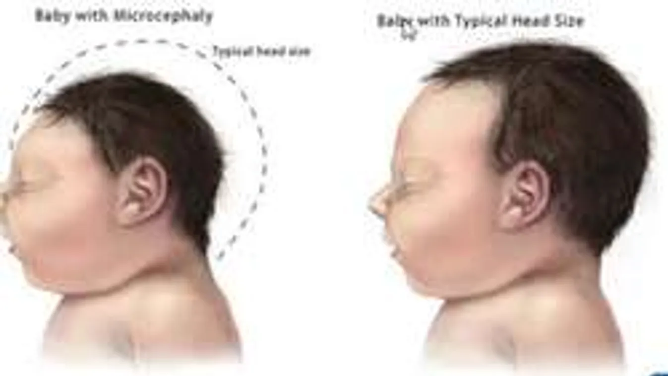 Szamárköhögés elleni oltóanyag indíthatta útjára a Zika-vírust!