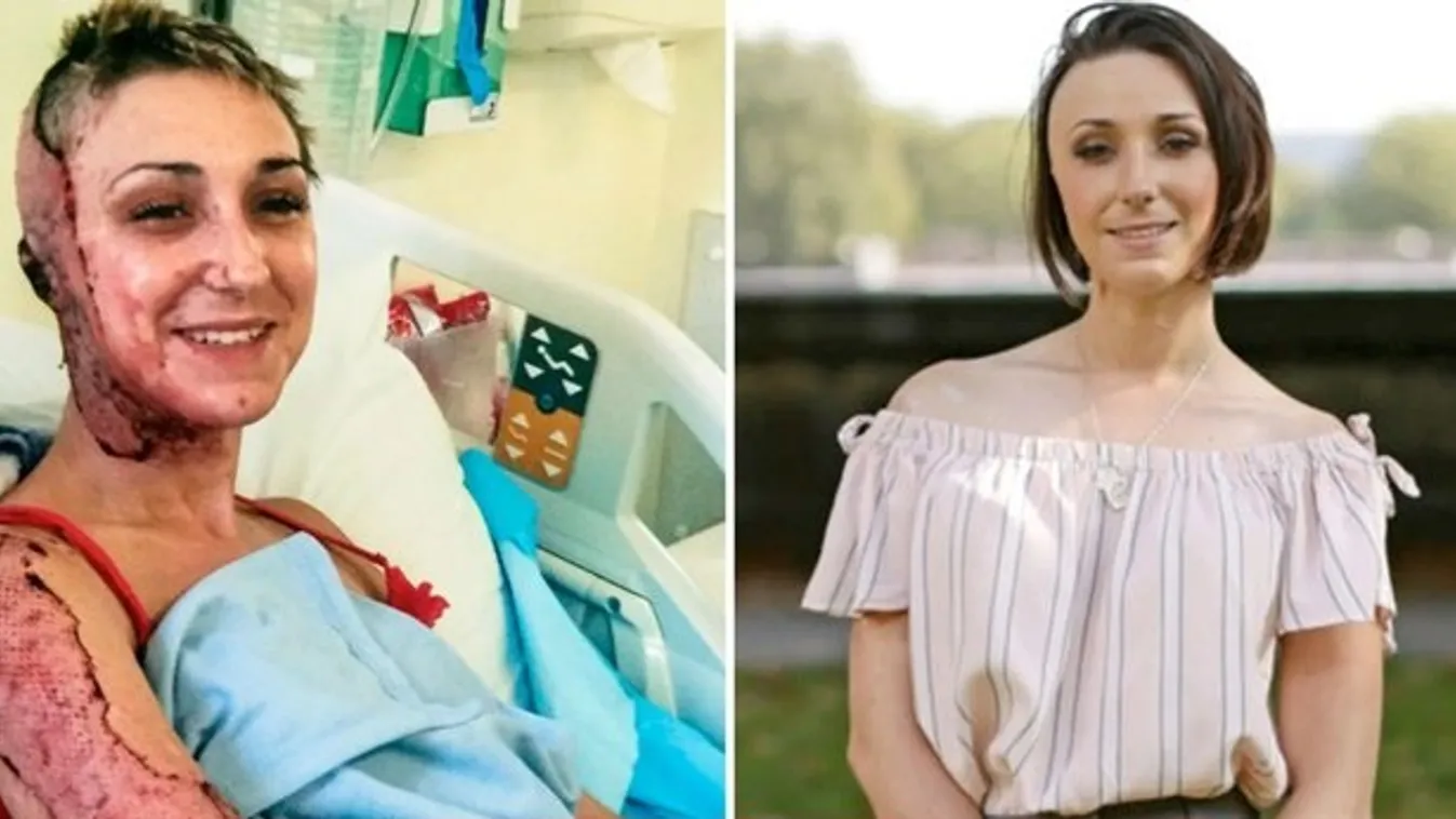 „Időnként azt kívántam, bárcsak megölt volna” – savval öntötték le a gyönyörű nő arcát