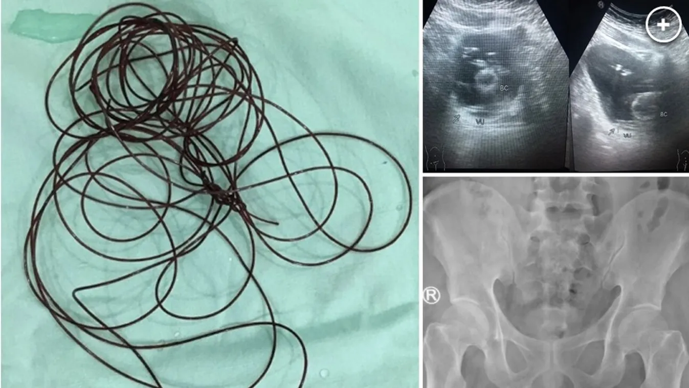 Szörnyű szexbalesetet szenvedett a 37 éves férfi