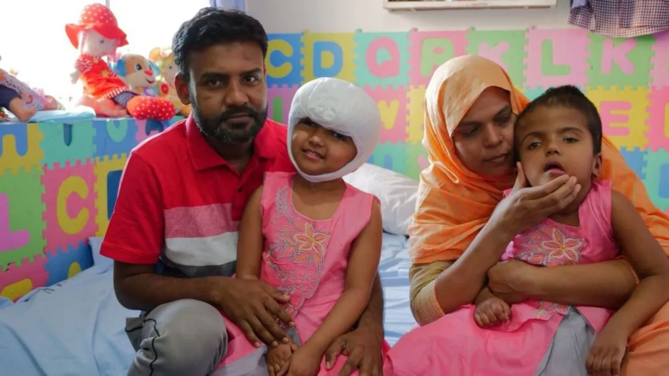 Szétválasztott ikrek: sürgős műtétet kellett végezni