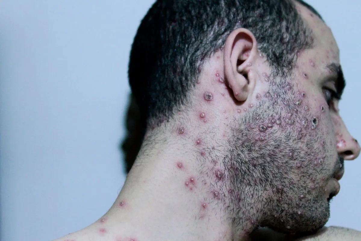 Adult,Man,Half,Face,With,Strong,Aggressive,Varicella.,Varicella,Monkey