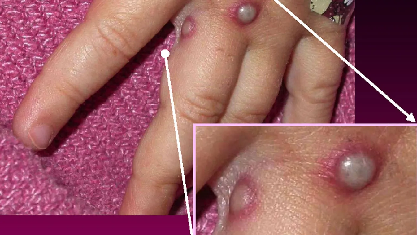 Intenzív osztályon kezelnek egy majomhimlős gyereket