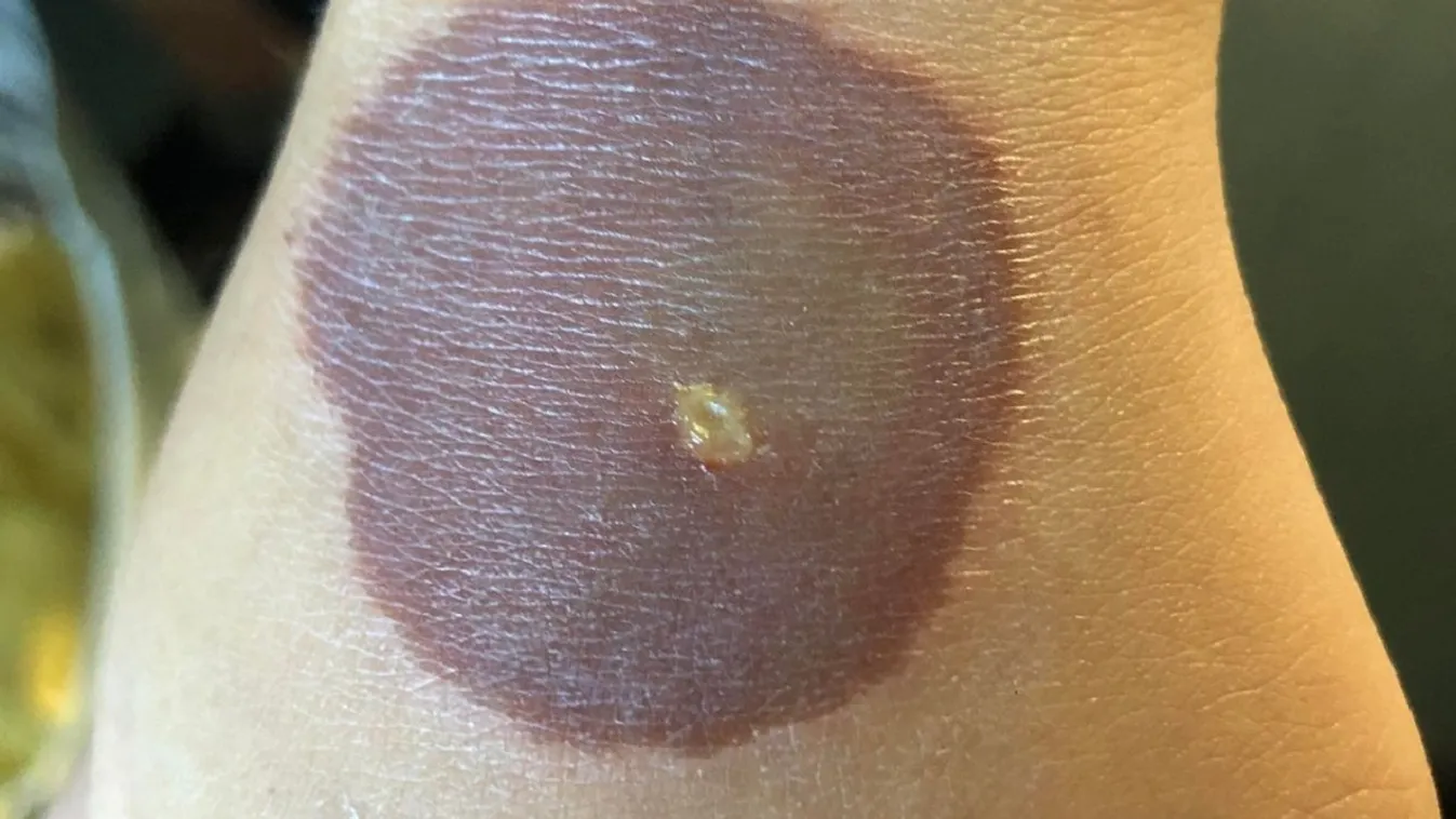 Azonnal műteni kellett a 10 éves lányt