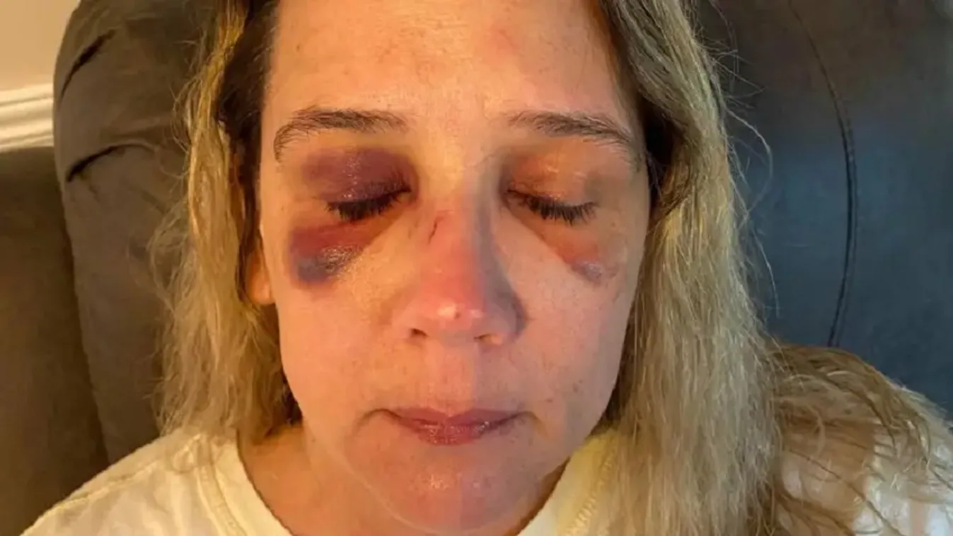 Saját testével védte lányait az anya, brutálisan összeverték