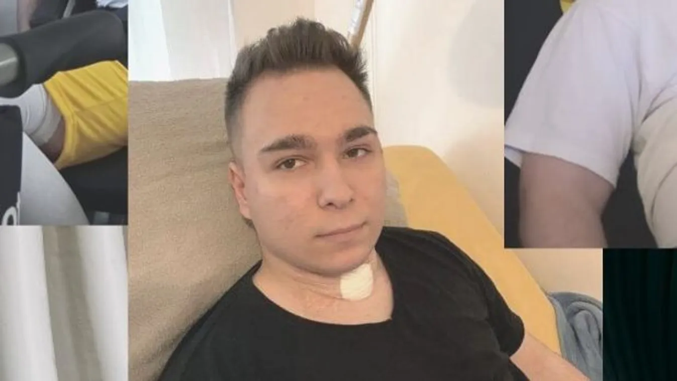 Megműtötték a horrorbalesetet szenvedett Dávidot