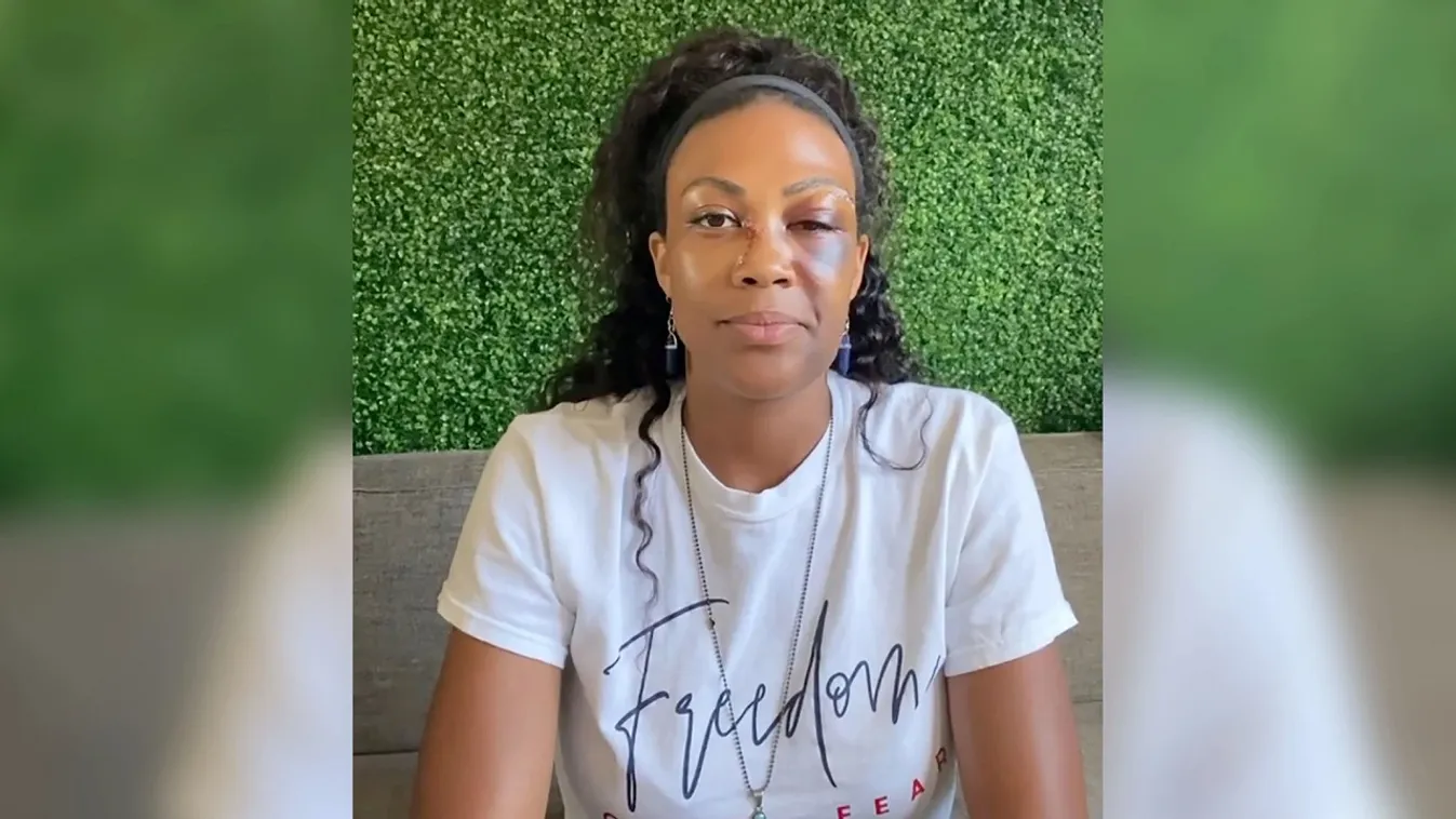 Majdnem megvakult a gyönyörű olimpikon