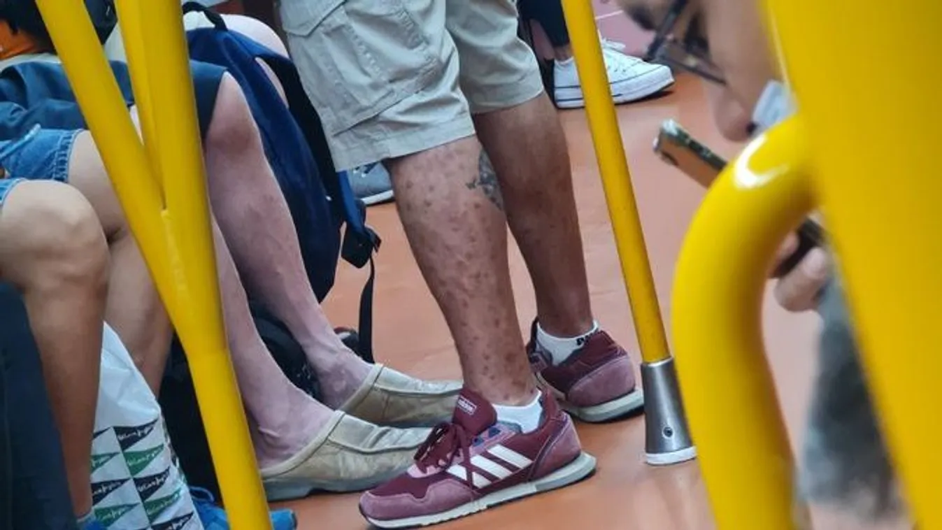A tömött metrón vette észre az orvos a majomhímlő tüneteit