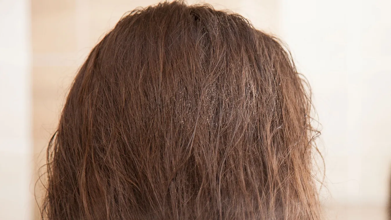 Iskolakezdés: a becsengetéssel a fejtetűszezon is elkezdődik