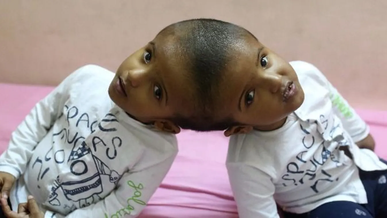 Csodát vittek a magyar orvosok Bangladesbe