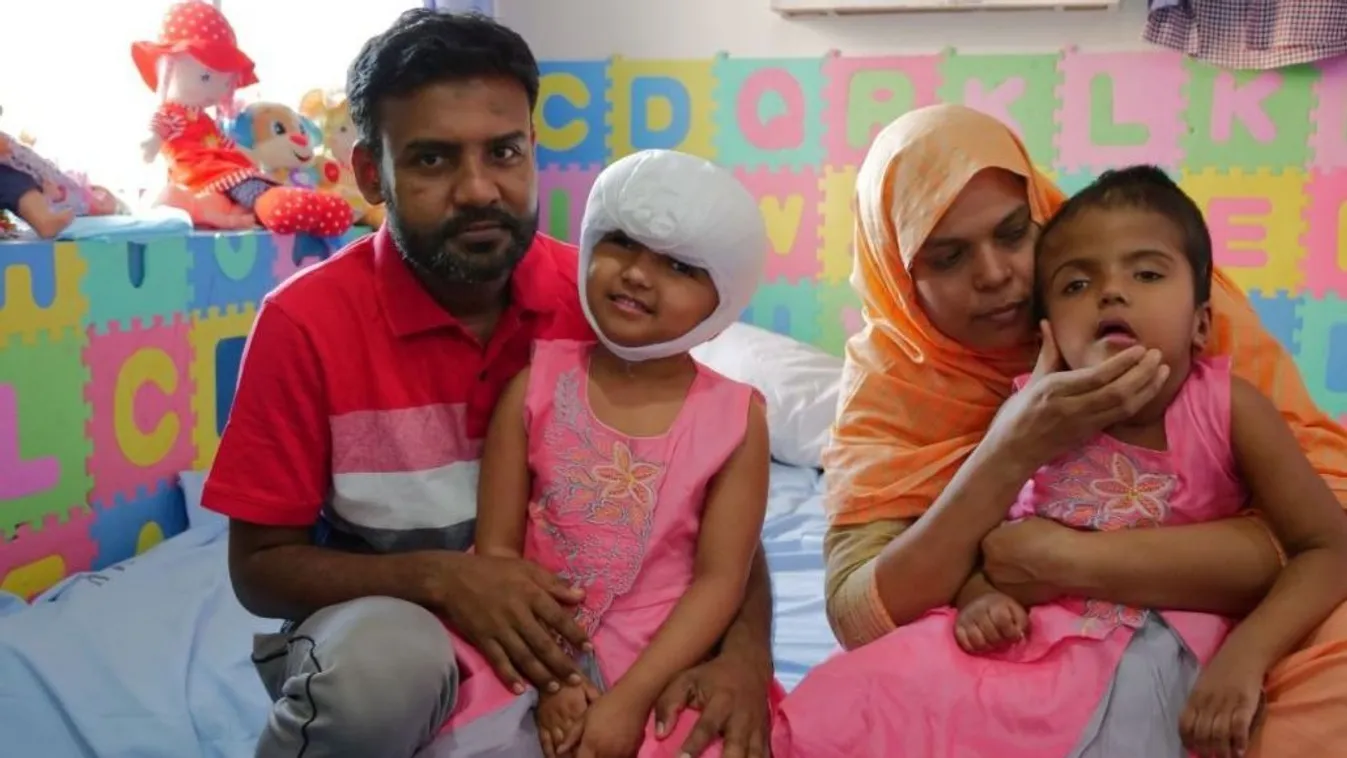 Szétválasztott sziámi ikrek: újabb műtétet végeztek Rukayán