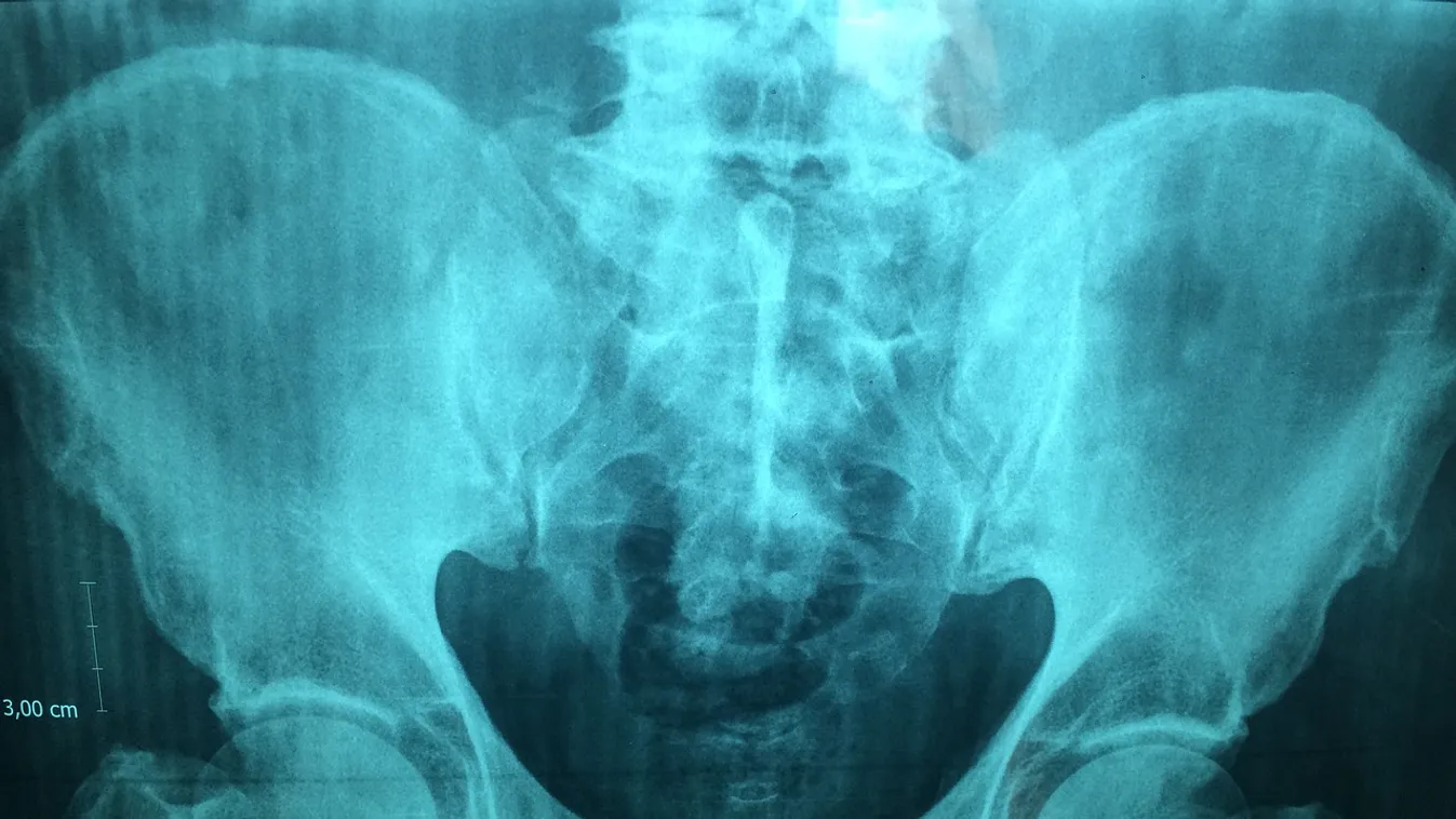 Sokkot kaptak az orvosok: ezt dugta fel magának a 12 éves