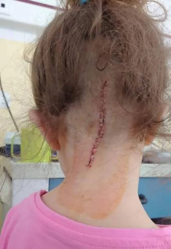 Vanda, 4 éves agydaganatot túlélő kislány