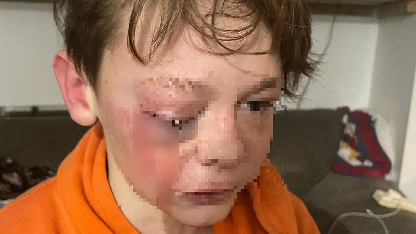 Horrortámadás: véresre verték a 12 éves kisfiút
